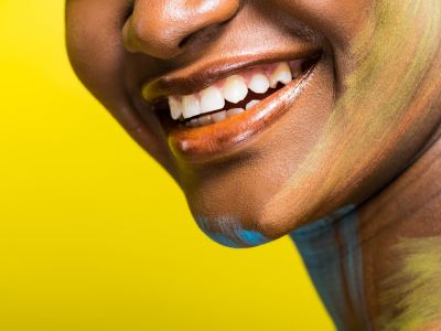 Bonding zębów | Co to i czy warto?